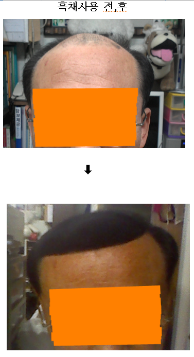 흑채사용전후사진(정면).png