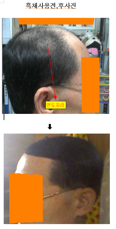 흑채사용전후사진(우측).png
