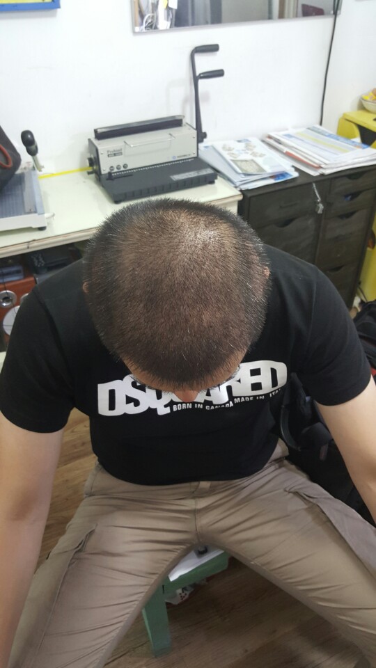 시술 거의한달.jpg