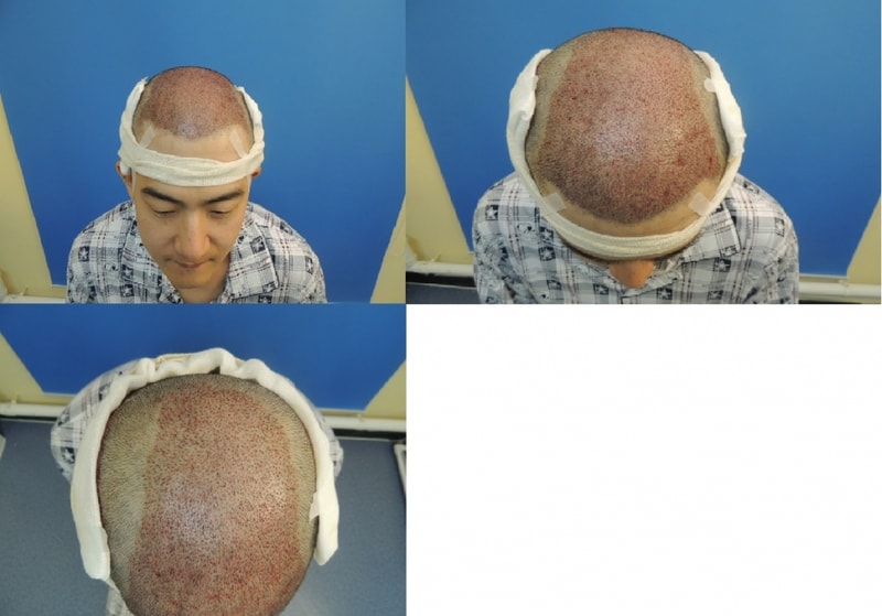 시술당일사진3개.jpg