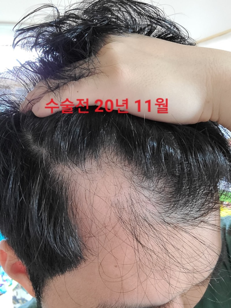 수술 전 좌.jpg