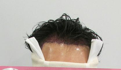 수술직후.JPG