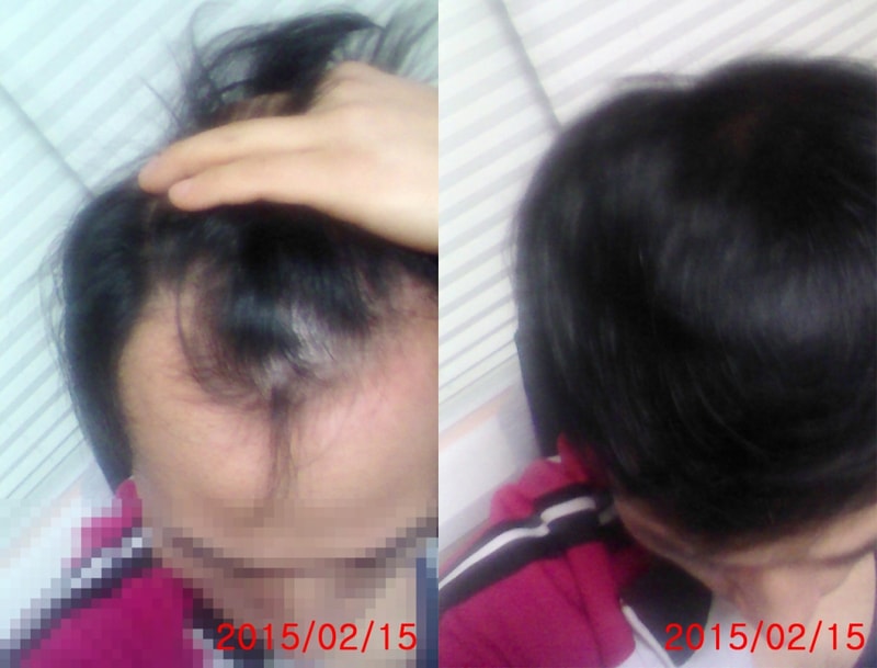 20150215수술전날.jpg