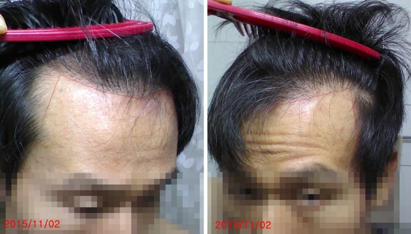현재 모발상태3.jpg