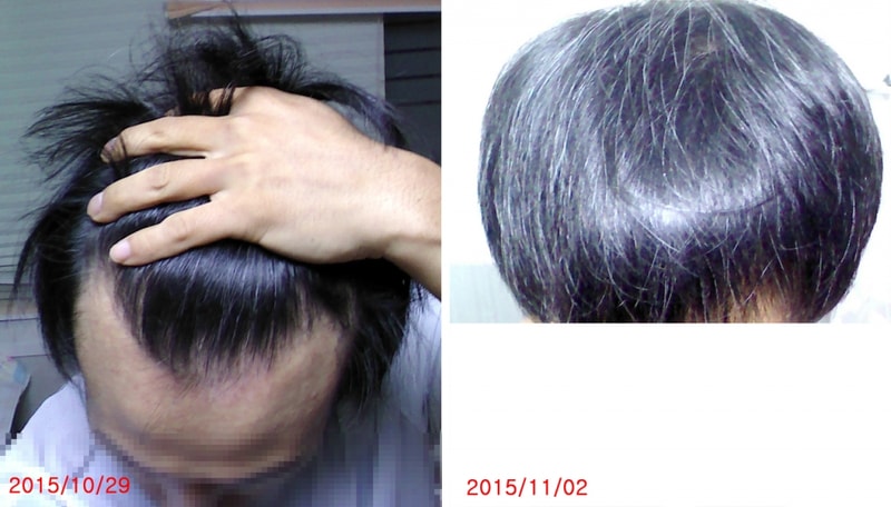 현재 모발상태1.jpg