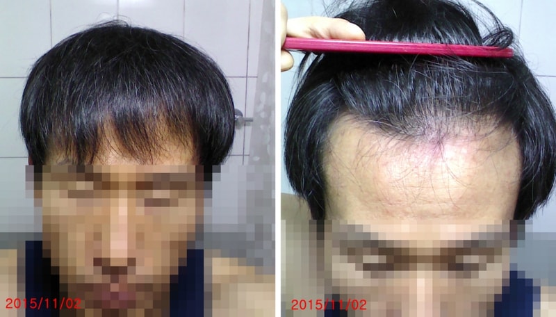 현재 모발상태2.jpg