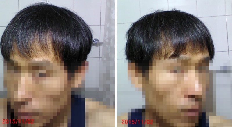 현재 모발상태4.jpg