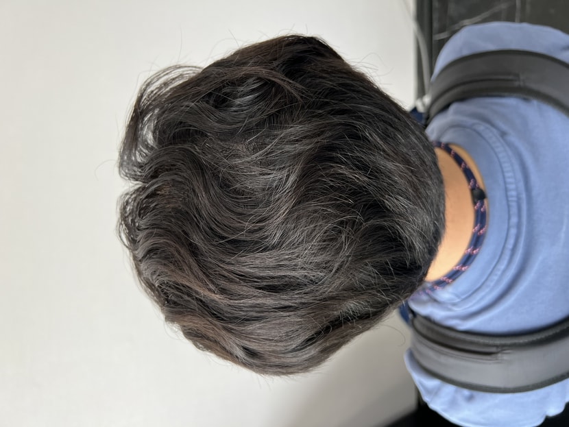 수술 후 1년 경과 사진입니다