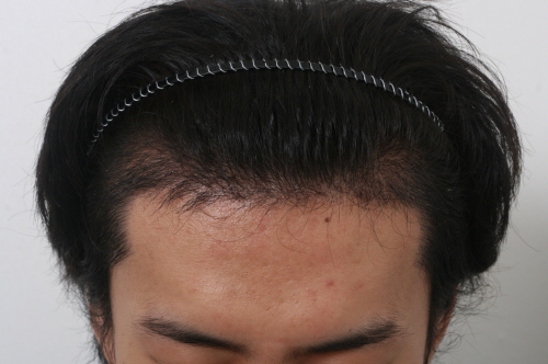 2주경과.jpg
