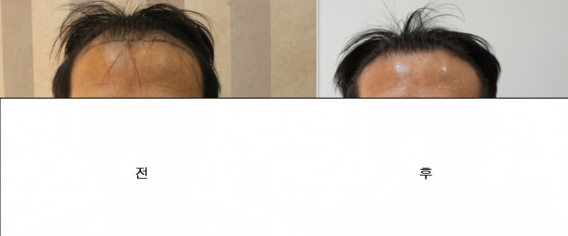 수술전후사진1.png