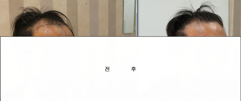 수술전후2.png
