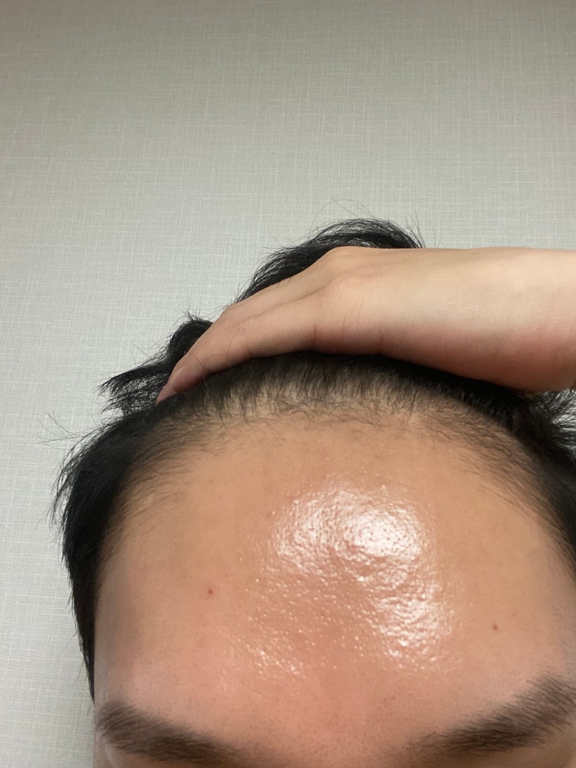 모발이식전