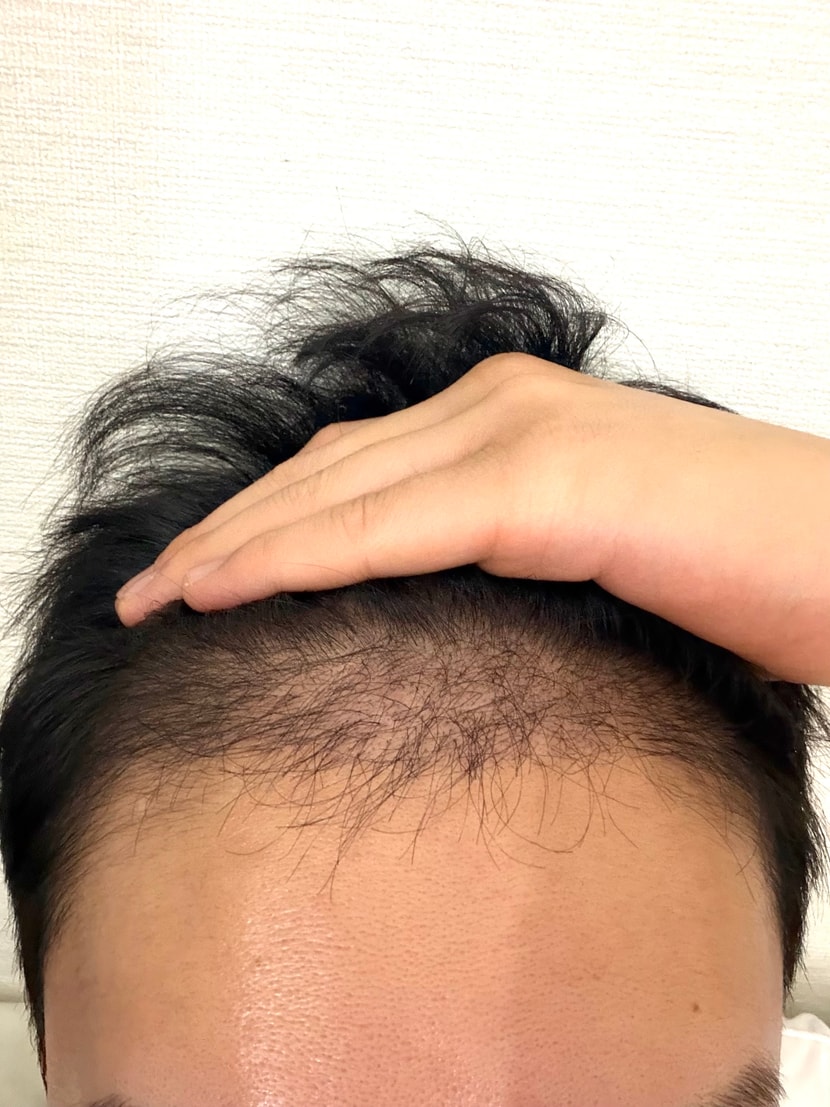 모발이식3개월차