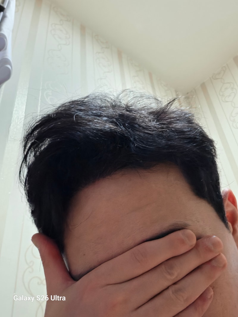 모발이식