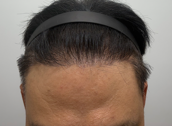앞(후).png