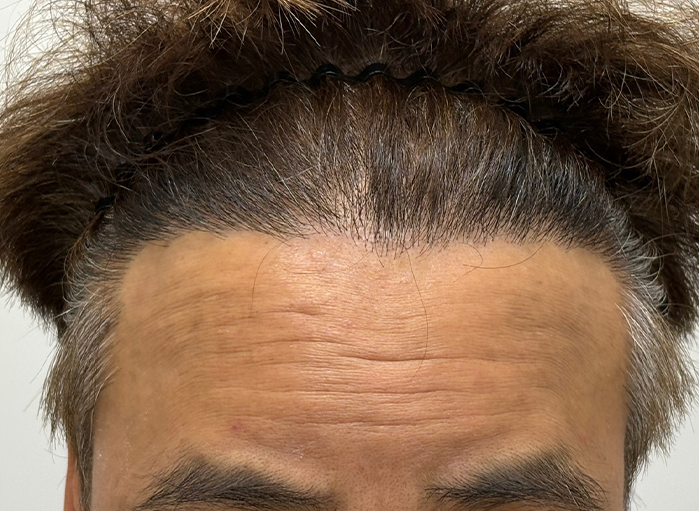 앞(후).png