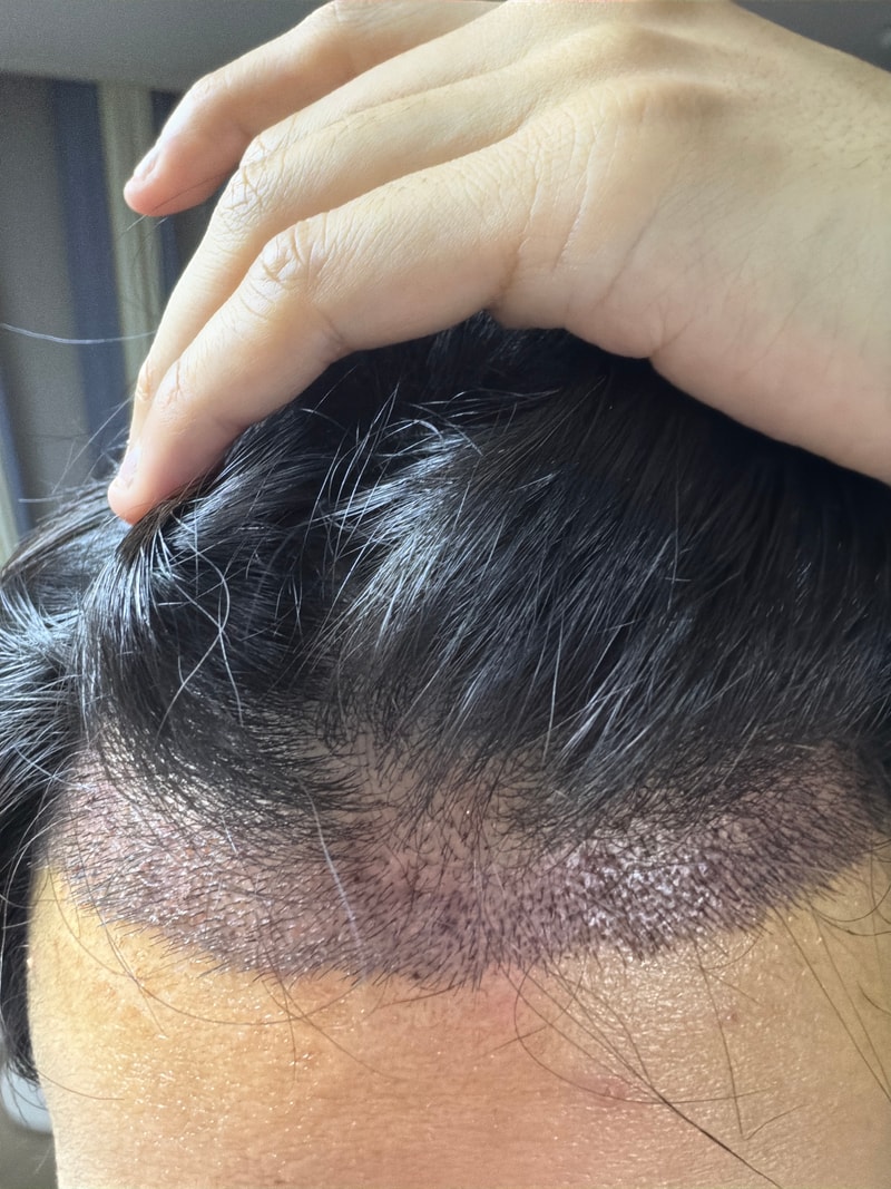 Day 3 of Hair Transplant
