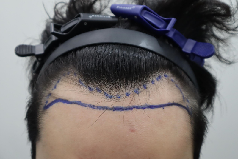 After a year, until reinforcement