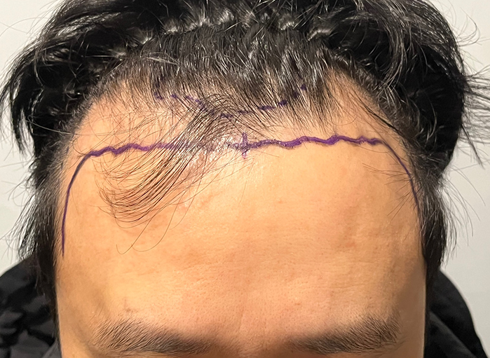 Hairline and M-shape successful. I recommend Gangnam Do Dream.