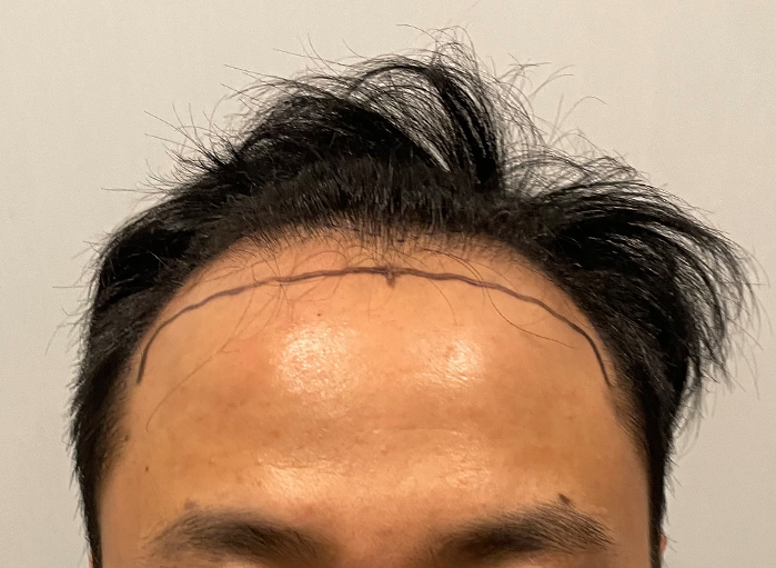 비절개 헤어라인, M자 모발이식 3300모 후기입니다. (강남역 두드림)