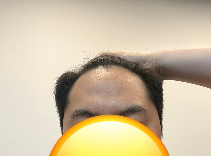모발이식 몃모 정도 필요할까요