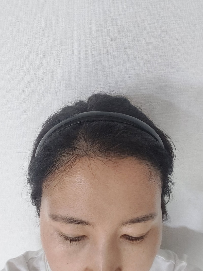 강남 뉴헤어 모발이식 6개월차 후기