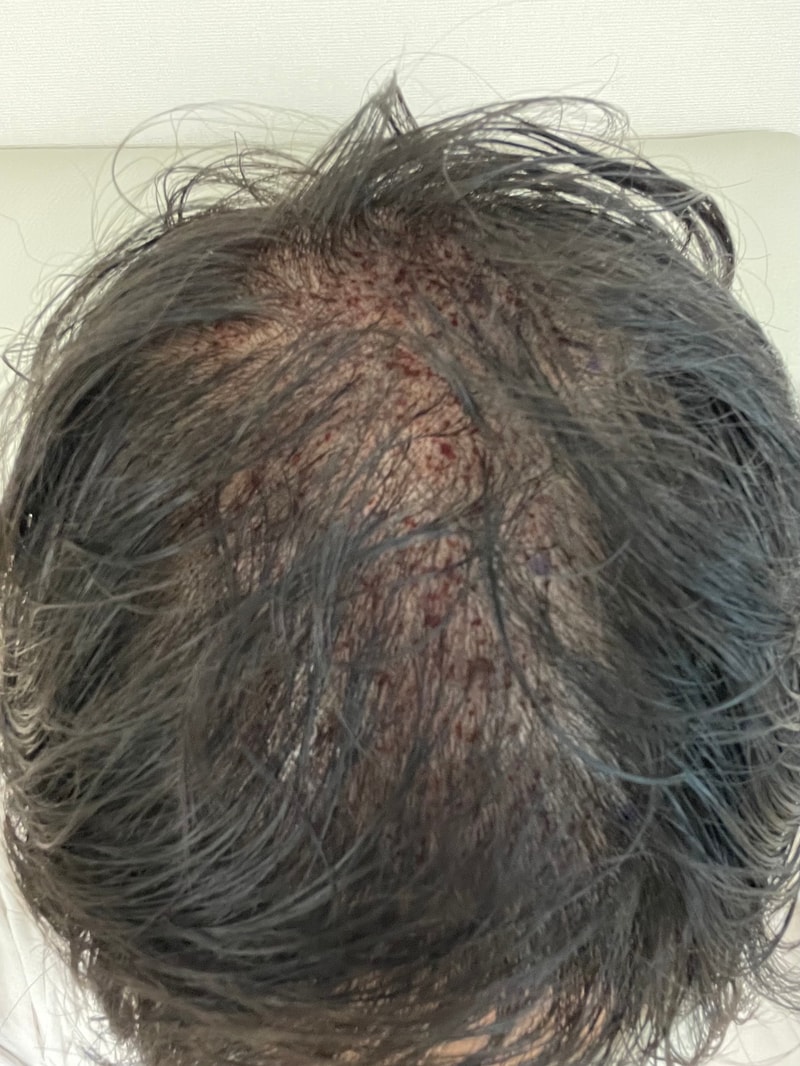 It's the 2nd day of Hair Transplant.