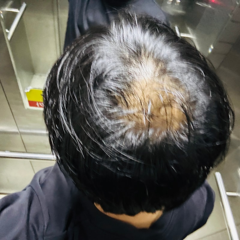 Hair Transplant during parental leave