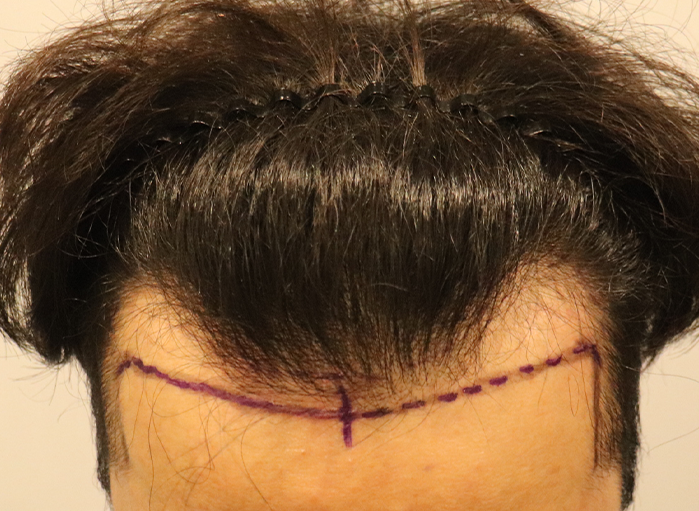 From temples to hairline, I'm writing a review of the M-shaped Hair Transplant tapping plastic surgery.