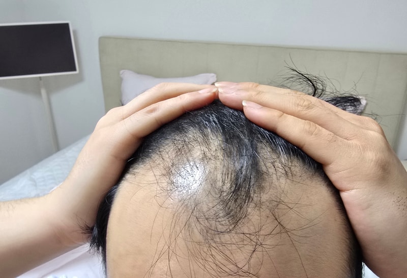 모발이식