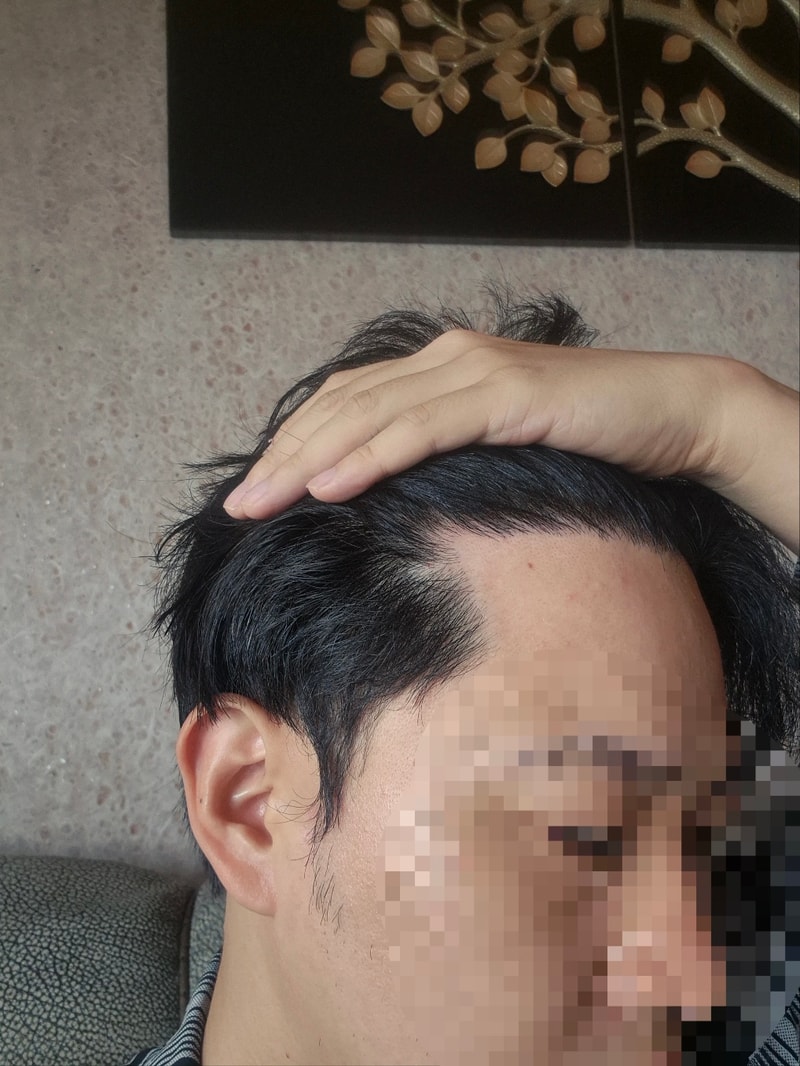모발이식