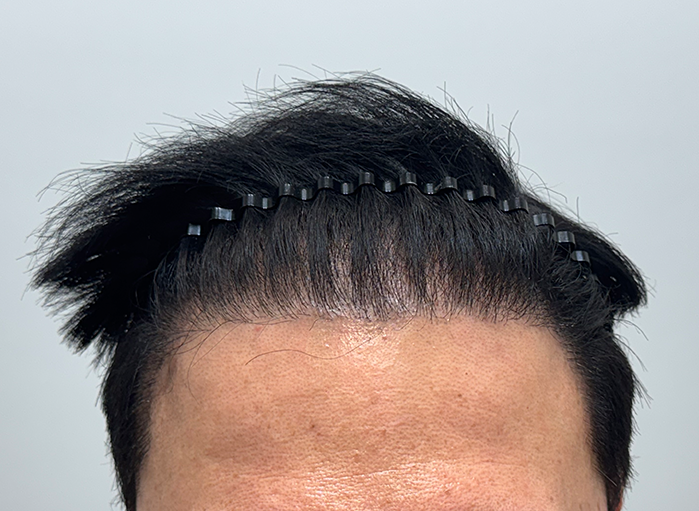 두드림성형외과 모발이식한지 1년차 후기입니다