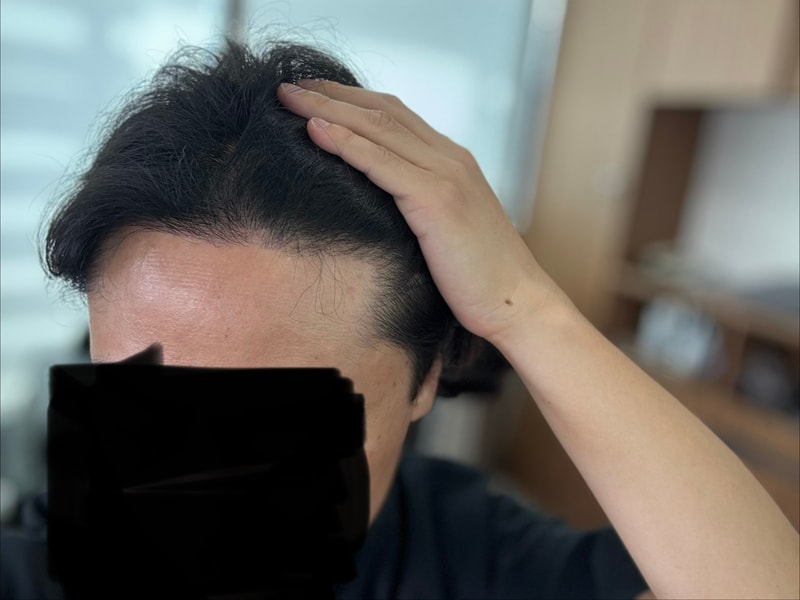 모재성의원 8개월차 (비절개2000모낭, 정수리 가르마, M자)