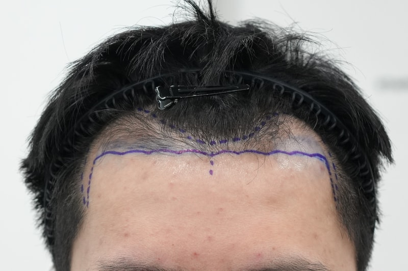 [연세모에버의원] 비절개로 2700모 심었어요