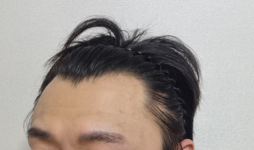 비절개 모발이식 3500모 ! 이식한지 벌써 2주가 되었네요 ㅎㅎ