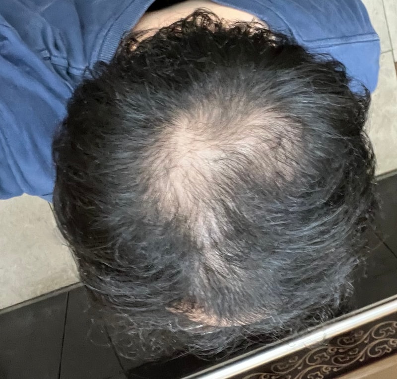 모발이식이랑 가발 중에 고민중입니다