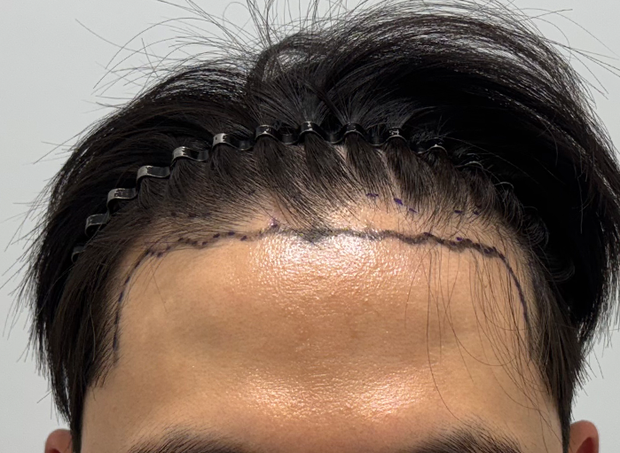 비절개 모발이식 2100모 1년 경과입니다