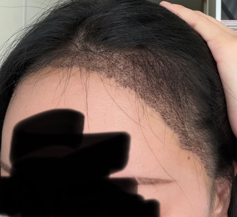 모발이식 디자인과 밀도