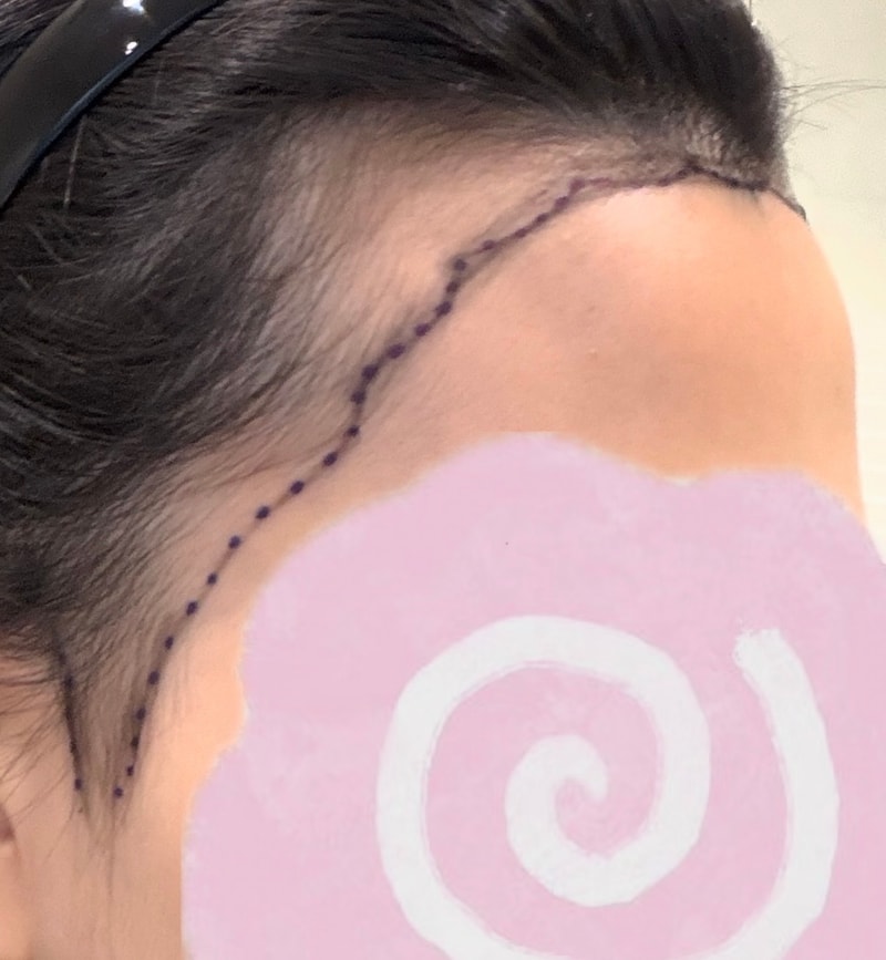 헤어라인10개월차
