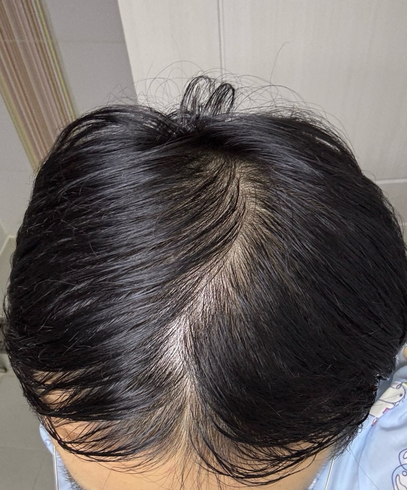 탈모약 복용 2개월 차 모발이식 고민입니다.