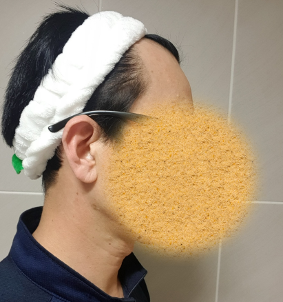 모발이식 하기 전 사진