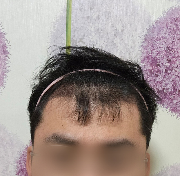 류형빈_모발_240203_수술후2주_1.jpg