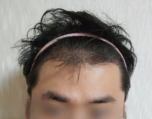 류형빈_모발_240203_수술후1주_1.jpg