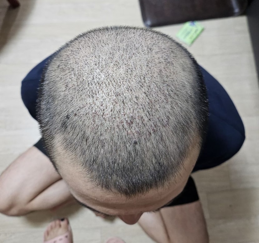 지문샴푸 후 