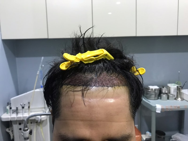 머리이식2.jpg