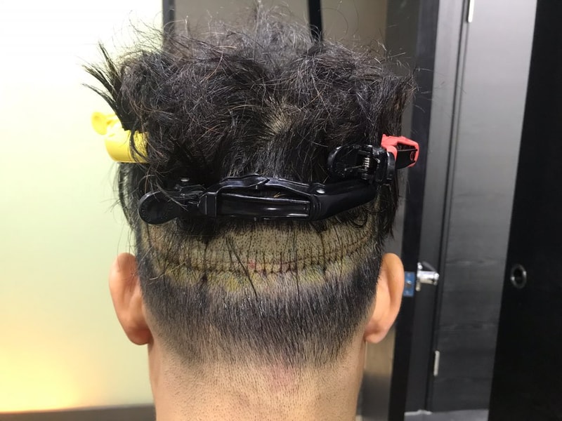 머리이식1.jpg