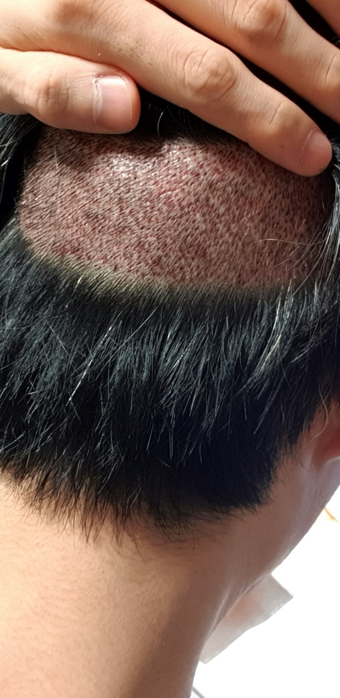 12.2후두부1.jpg