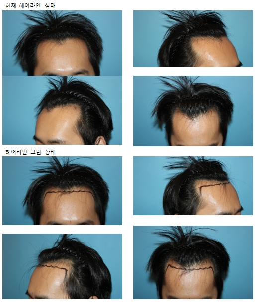 헤어라인 상태.jpg