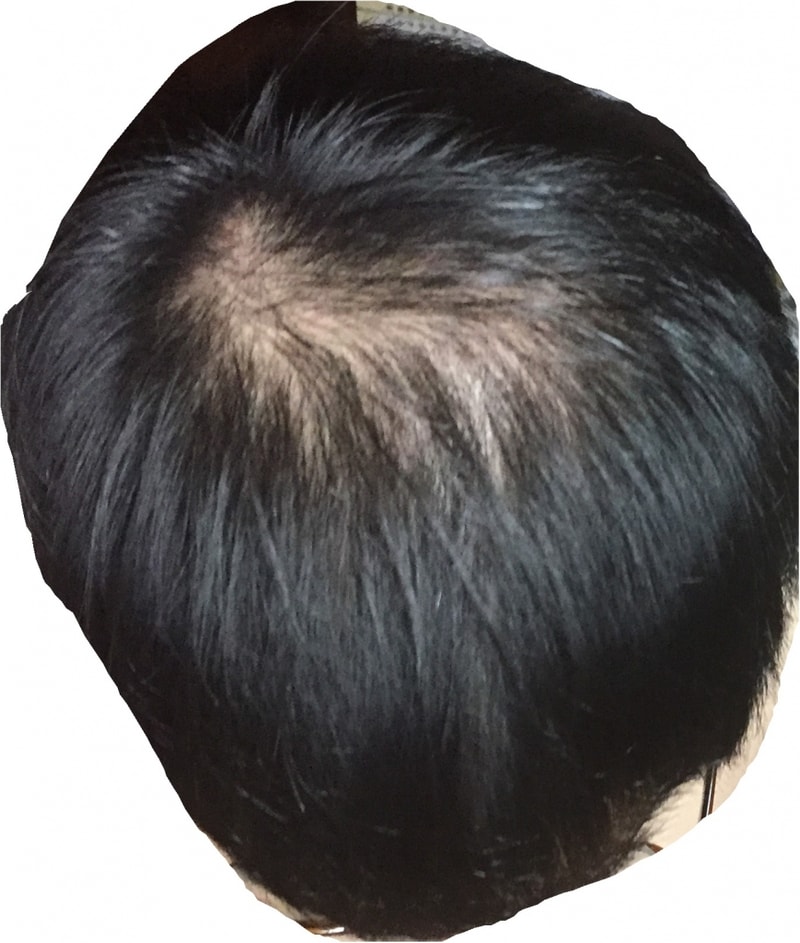 수술1개월전1 (1).jpg