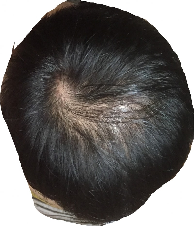 수술1개월전1 (2).jpg